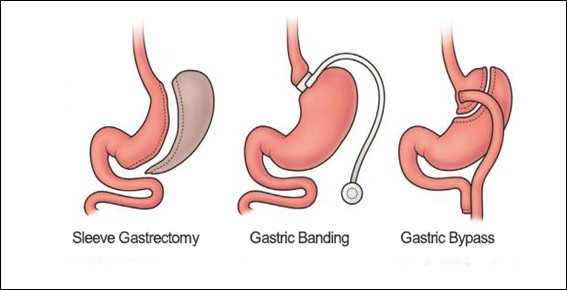 Bariatric-surgery